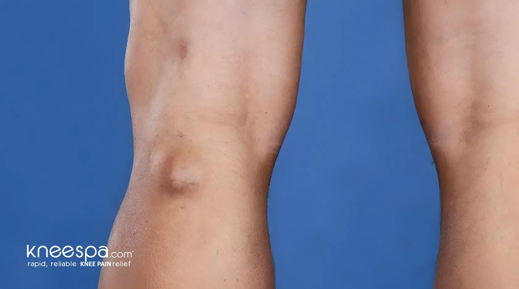 Bakers Cyst