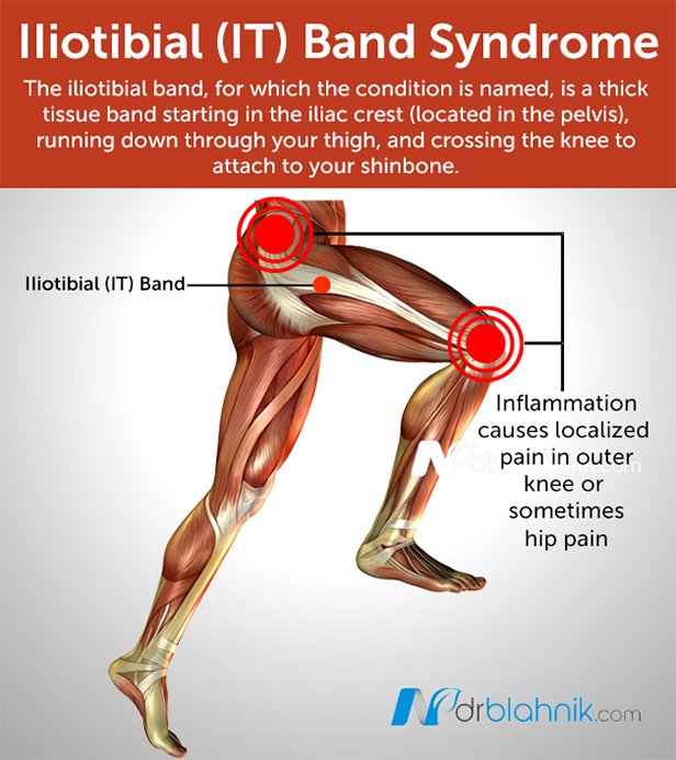 Iliotibial Band Syndrome