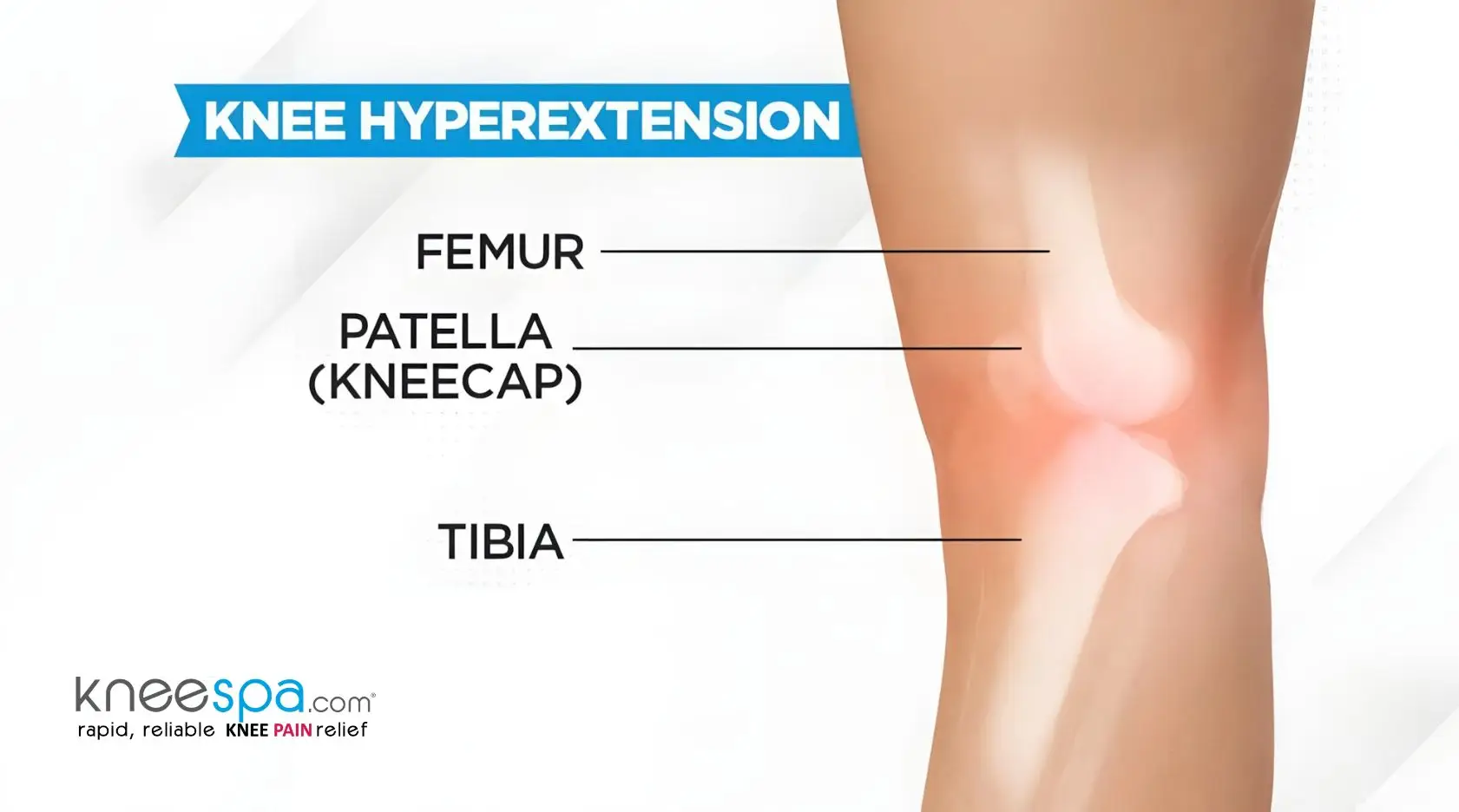 Knee hyperextension