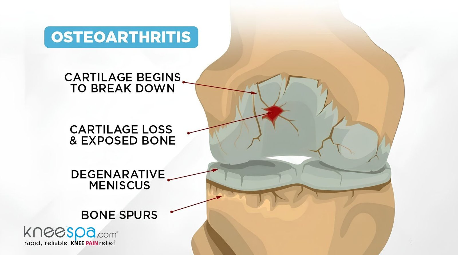 Osteoarthritis