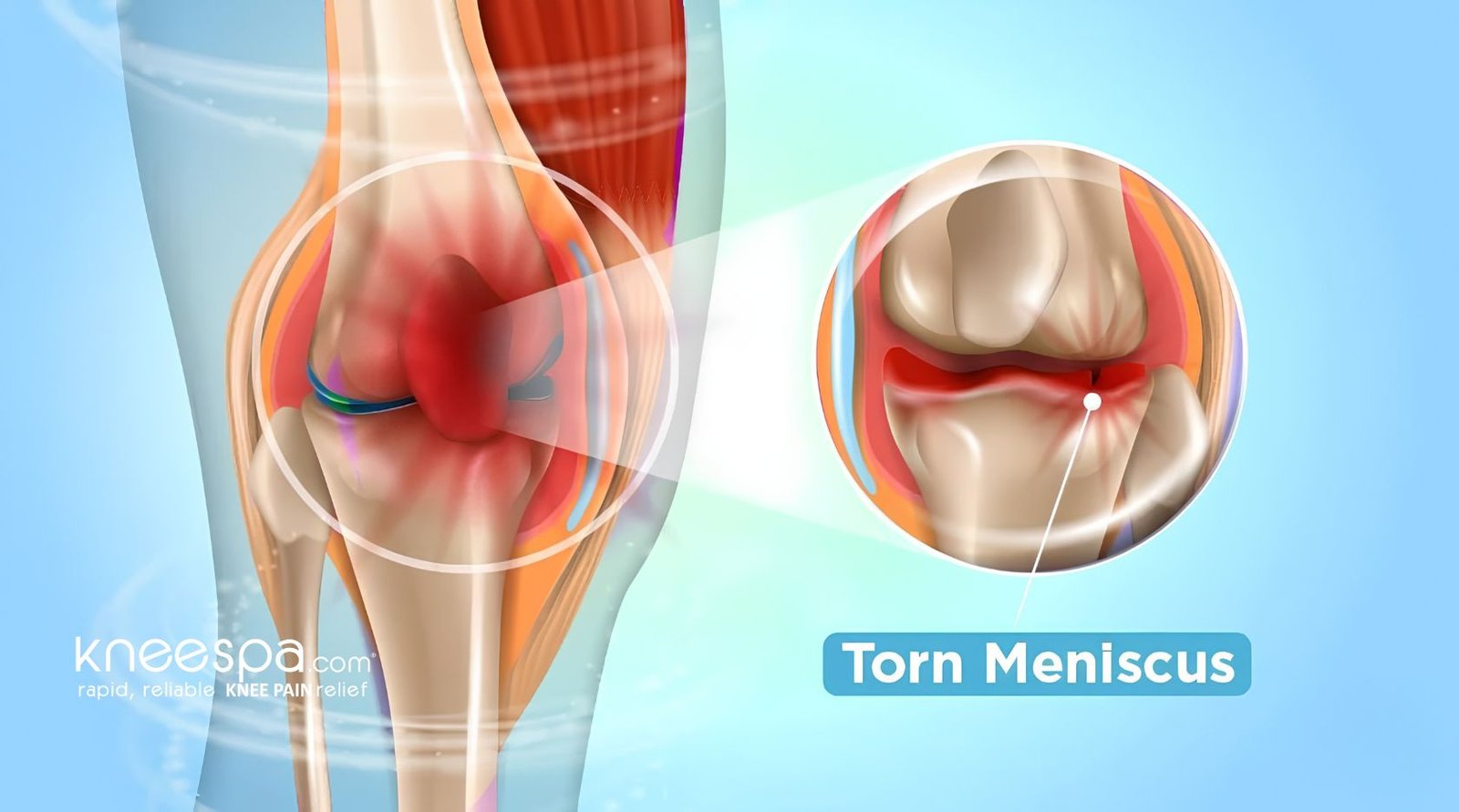 Torn Meniscus